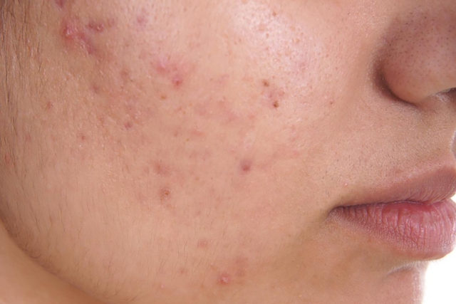 Chấm dứt nỗi lo da bị thâm mụn trong 4 tuần, da trắng sáng đều màu- Ảnh 4.
