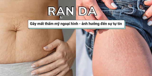 Rạn da: Nguyên nhân, cách phòng ngừa và giải pháp điều trị hiệu quả ngay tại nhà - Ảnh 1.