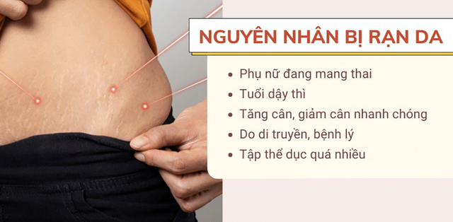 Rạn da: Nguyên nhân, cách phòng ngừa và giải pháp điều trị hiệu quả ngay tại nhà - Ảnh 2.