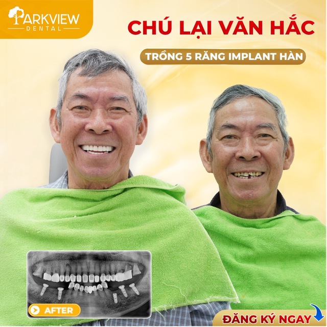 Trồng implant tại Nha khoa Parkview - Giải ph&aacute;p hiệu quả cho người mất răng - Ảnh 1.