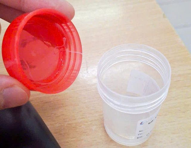 Ký sinh trùng 10 cm sống trong mắt bệnh nhân- Ảnh 1.