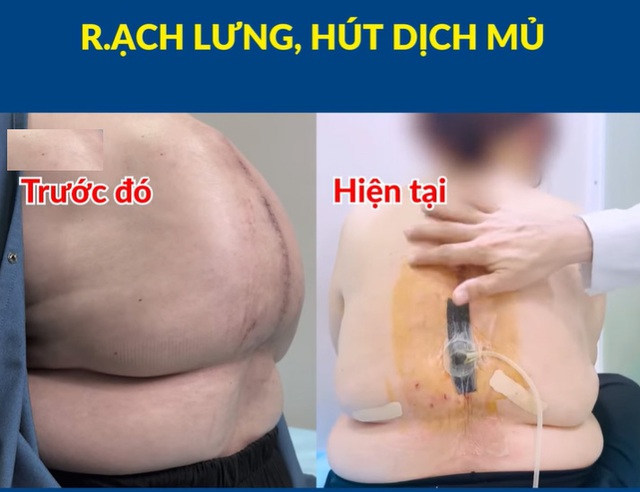 Rạch khối u, hút 2 lít dịch mủ từ lưng người phụ nữ - Ảnh 1.
