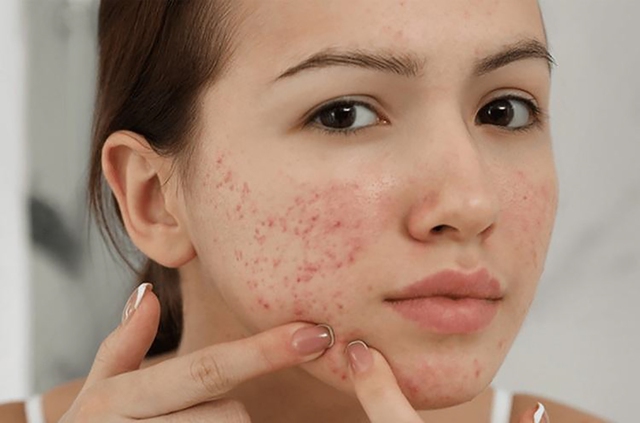 Những điều cần làm sau khi lấy nhân mụn- Ảnh 2.