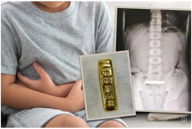 Cậu bé 11 tuổi nuốt thỏi vàng 100 gam gây chấn động - Ảnh 1.