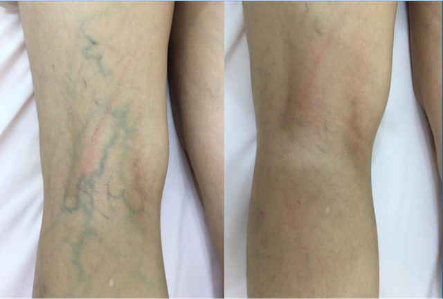Vì sao nhân viên y tế dễ bị suy giãn tĩnh mạch chân?- Ảnh 1.