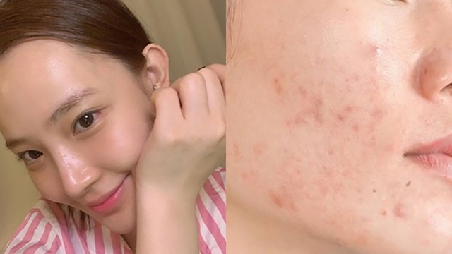 Chăm sóc da sau khi nặn mụn đúng chuẩn y khoa ngăn ngừa sẹo thâm, sẹo rỗ - Ảnh 1.
