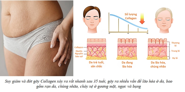 Rạn da sau sinh và hành trình tìm lại sự tự tin - Ảnh 2. Rạn da sau sinh và hành trình tìm lại sự tự tin - Ảnh 2.