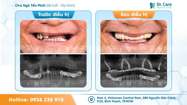 Trồng implant tuổi trung niên, chọn sức khỏe hay chi phí rẻ? - Ảnh 2.