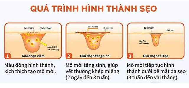 97% người bỏ lỡ thời điểm vàng trị sẹo phẫu thuật - Bạn trong số đó? - Ảnh 2.