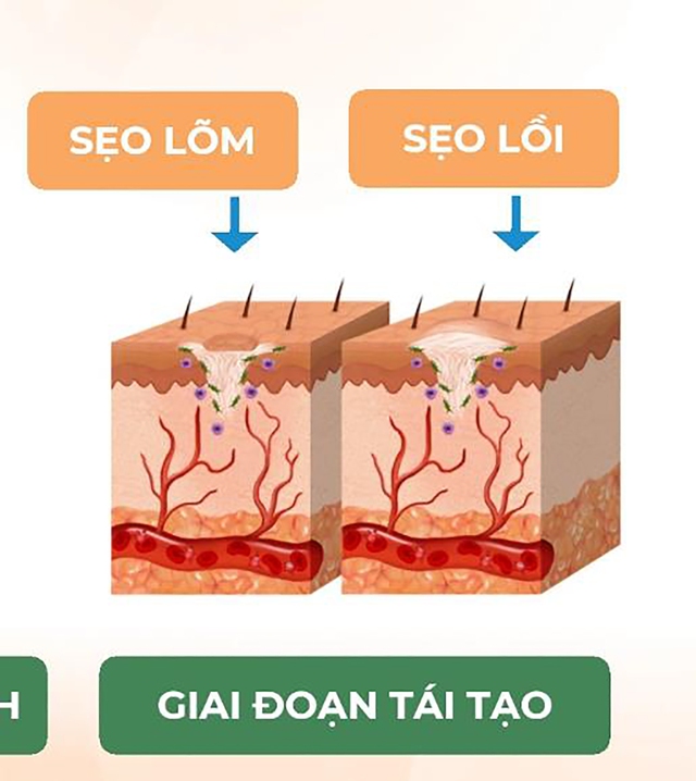 97% người bỏ lỡ thời điểm vàng trị sẹo phẫu thuật - Bạn trong số đó? - Ảnh 3.