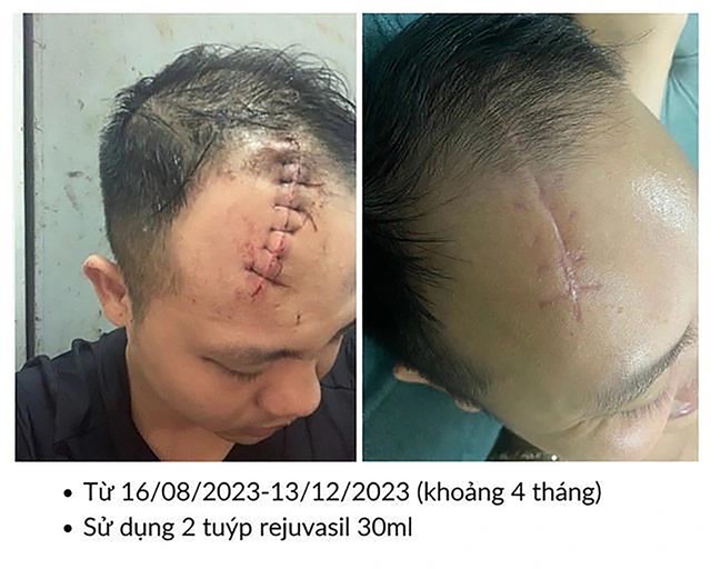 97% người bỏ lỡ thời điểm vàng trị sẹo phẫu thuật - Bạn trong số đó? - Ảnh 8.