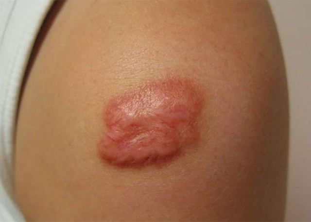 Đánh giá hiệu quả và khuyến nghị y khoa trong trị sẹo lồi với silicone y tế- Ảnh 2. Đánh giá hiệu quả và khuyến nghị y khoa trong trị sẹo lồi với silicone y tế- Ảnh 2.