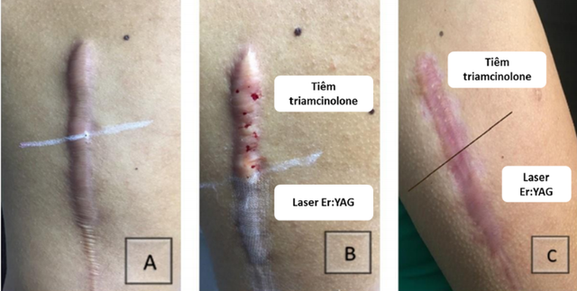 Đánh giá hiệu quả và khuyến nghị y khoa trong trị sẹo lồi với silicone y tế- Ảnh 3. Đánh giá hiệu quả và khuyến nghị y khoa trong trị sẹo lồi với silicone y tế- Ảnh 3.