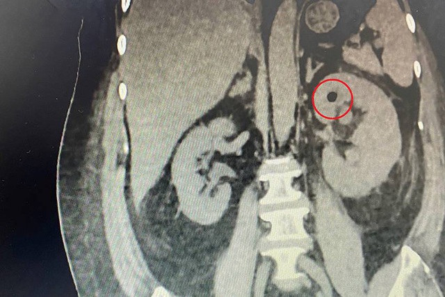 Sỏi l&agrave;m thận sinh kh&iacute; khiến người phụ nữ suy thận, suy gan nguy kịch - Ảnh 1.