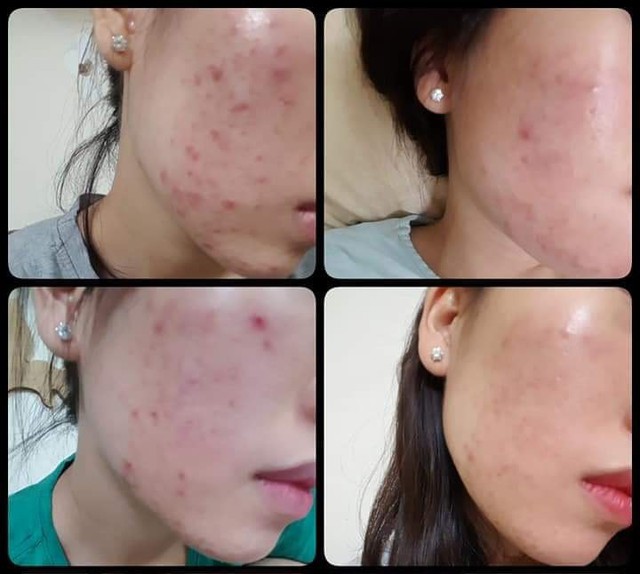Top 12 kem trị mụn hiệu quả, không để lại thâm Top 12 kem trị mụn hiệu quả, không để lại thâm