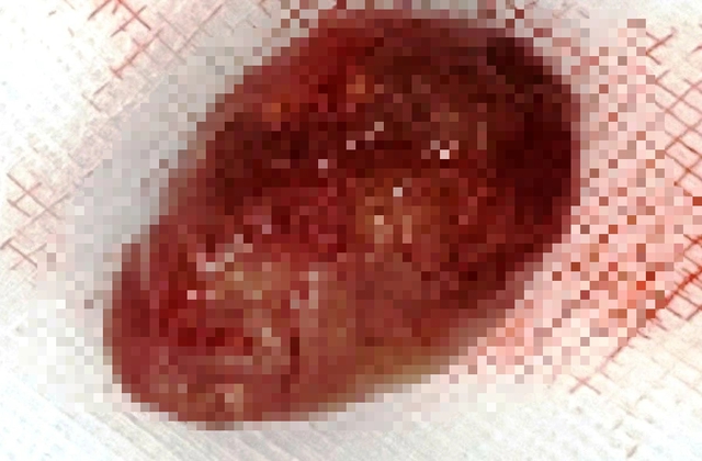 Phẫu thuật cắt bỏ thành công khối u trong tuyến mang tai hiếm gặp- Ảnh 1. Phẫu thuật cắt bỏ thành công khối u trong tuyến mang tai hiếm gặp- Ảnh 1.