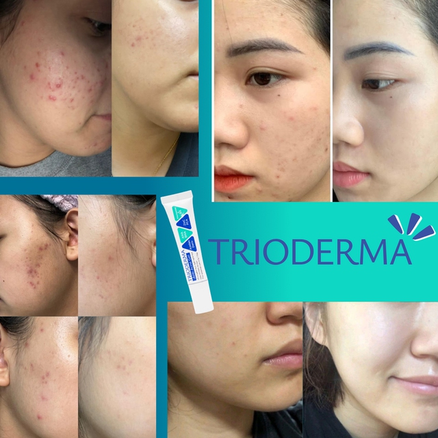 Đột phá mới từ PAD - dẫn xuất Azelaic thế hệ mới trị mụn, sáng da - Ảnh 3.