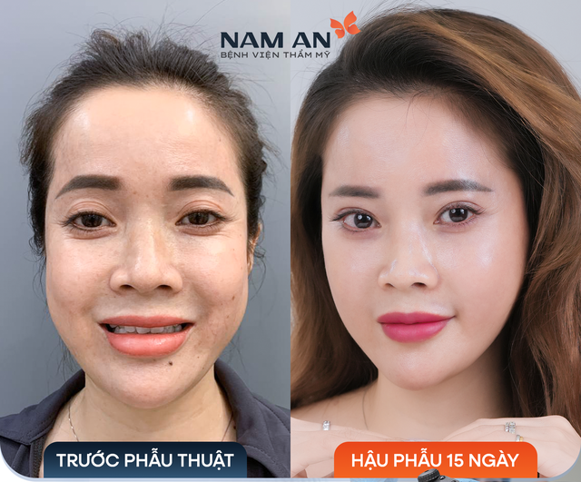 Bệnh viện thẩm mỹ Nam An – Địa chỉ căng da mặt nội soi uy tín - Ảnh 3.