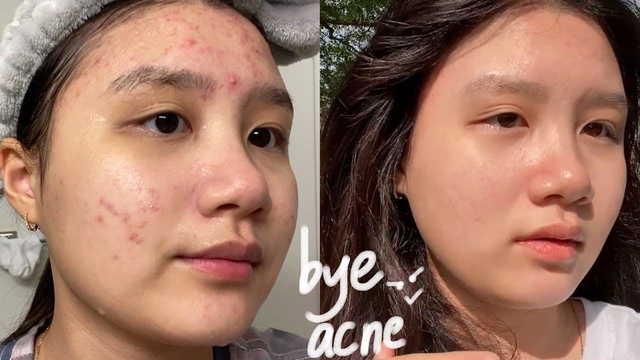 Top 12 kem trị mụn cho da dầu được gen Z, gen Alpha tìm mua nhiều Top 12 kem trị mụn cho da dầu được gen Z, gen Alpha tìm mua nhiều