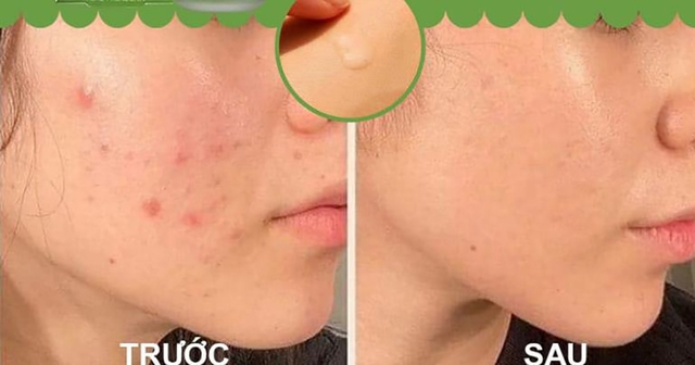 Top 12 kem trị mụn cho da dầu được gen Z, gen Alpha tìm mua nhiều - Ảnh 6.