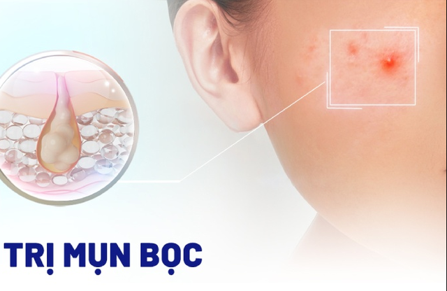 Top 10 kem trị mụn bọc ‘cứu tinh’ cho da dầu hết sưng, hết đau, không thâm Top 10 kem trị mụn bọc ‘cứu tinh’ cho da dầu hết sưng, hết đau, không thâm