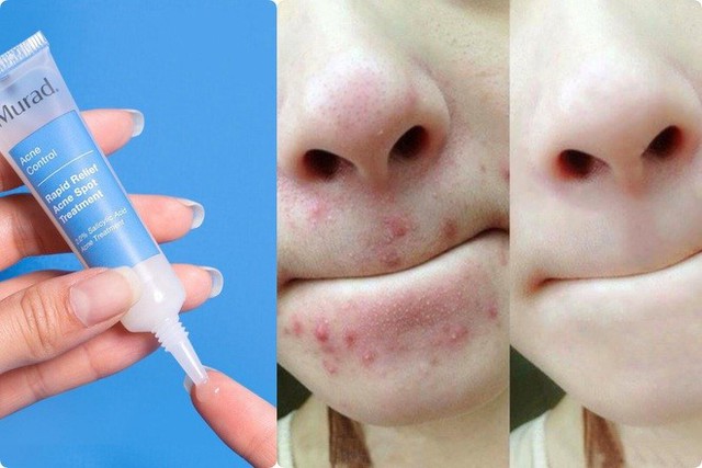 Top 10 kem trị mụn bọc 'cứu tinh' cho da dầu hết sưng, hết đau, không thâm- Ảnh 14. Top 10 kem trị mụn bọc 'cứu tinh' cho da dầu hết sưng, hết đau, không thâm- Ảnh 14.