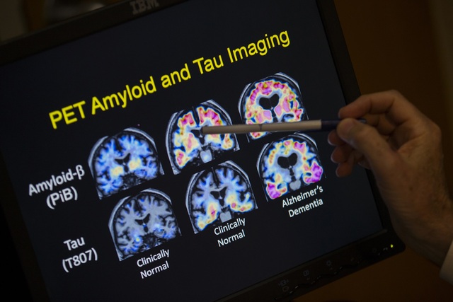 Xét nghiệm máu đầu tiên cho bệnh Alzheimer được Mỹ phê duyệt Xét nghiệm máu đầu tiên cho bệnh Alzheimer được Mỹ phê duyệt