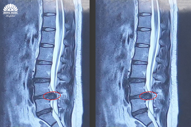 Nữ nh&acirc;n vi&ecirc;n văn ph&ograve;ng yếu liệt ch&acirc;n do tho&aacute;t vị đĩa đệm - Ảnh 1.