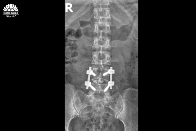 Nữ nh&acirc;n vi&ecirc;n văn ph&ograve;ng yếu liệt ch&acirc;n do tho&aacute;t vị đĩa đệm - Ảnh 2.