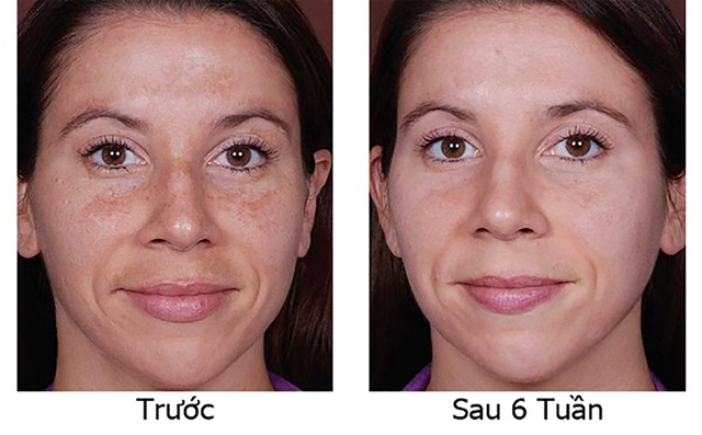 Arbutin là gì? Tác dụng đối với làn da và top 3 được tìm mua nhiều - Ảnh 9.