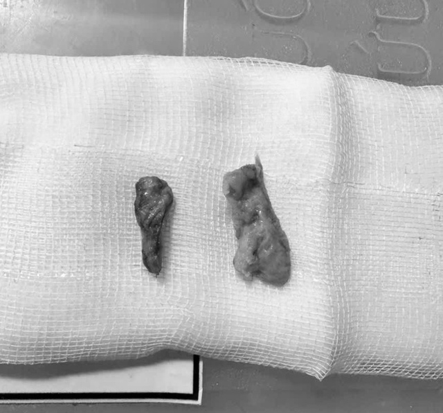 D&ugrave;ng giấy h&uacute;t đ&agrave;m, cụ &ocirc;ng nguy kịch v&igrave; dị vật rơi s&acirc;u v&agrave;o đường thở - Ảnh 2.