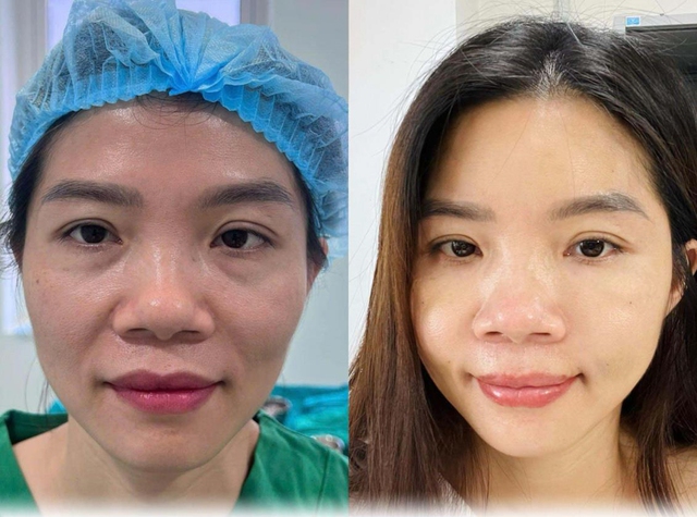 Làm đẹp với mỡ: Khắc phục mọi khuyết điểm cùng bác sĩ CK1 Tạ Trung Kiên- Ảnh 5.
