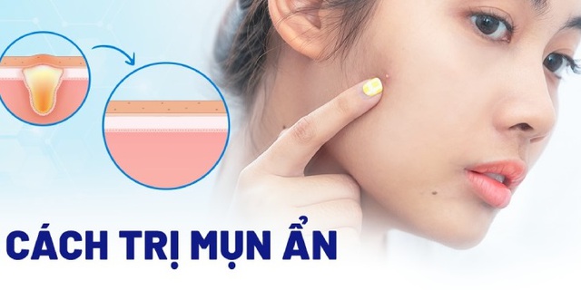 Bật mí cách trị mụn ẩn hiệu quả tại nhà, ngừa tái phát, không để lại sẹo Bật mí cách trị mụn ẩn hiệu quả tại nhà, ngừa tái phát, không để lại sẹo
