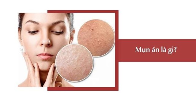 Bật mí cách trị mụn ẩn hiệu quả tại nhà, ngừa tái phát, không để lại sẹo - Ảnh 2.