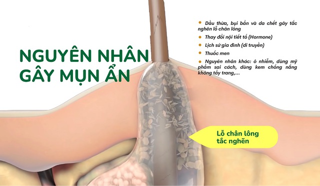 Bật mí cách trị mụn ẩn hiệu quả tại nhà, ngừa tái phát, không để lại sẹo - Ảnh 3.