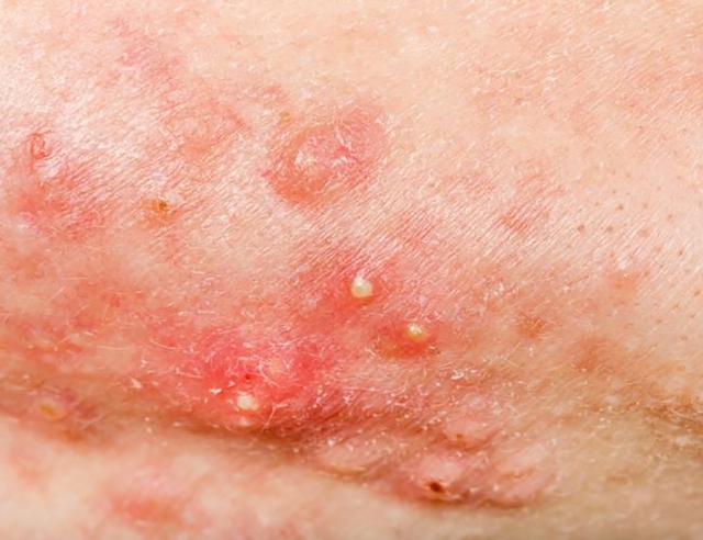 Scar Esthetique: Giải pháp kích tăng sinh collagen cho sẹo lõm mịn da- Ảnh 2. Scar Esthetique: Giải pháp kích tăng sinh collagen cho sẹo lõm mịn da- Ảnh 2.