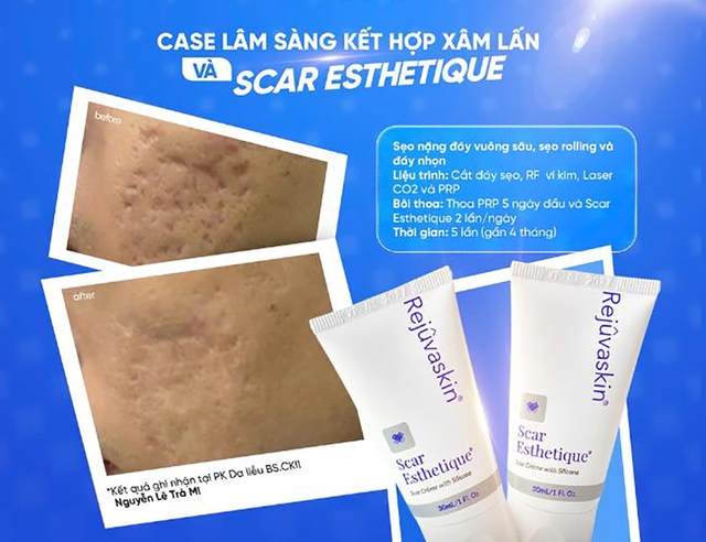 Scar Esthetique: Giải pháp kích tăng sinh collagen cho sẹo lõm mịn da- Ảnh 7. Scar Esthetique: Giải pháp kích tăng sinh collagen cho sẹo lõm mịn da- Ảnh 7.