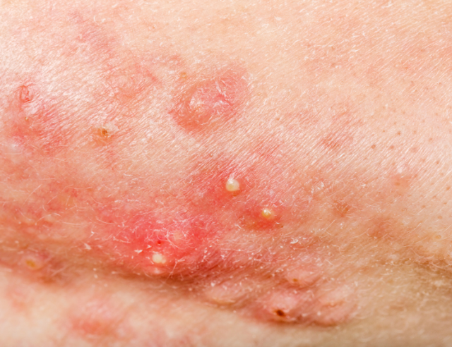 Scar Esthetique: Giải ph&aacute;p k&iacute;ch tăng sinh collagen cho sẹo l&otilde;m mịn da - Ảnh 2.