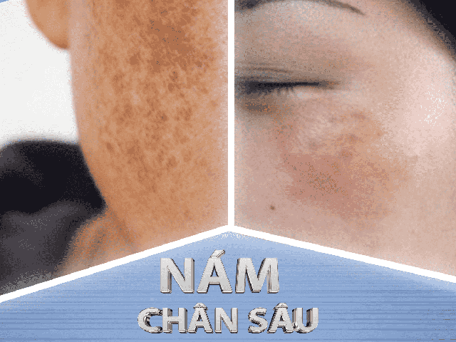 Top 6 kem trị nám chân sâu hiệu quả tại nhà, ngừa tái phát, không bong tróc Top 6 kem trị nám chân sâu hiệu quả tại nhà, ngừa tái phát, không bong tróc