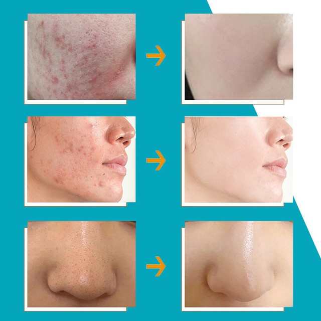 Top 5 kem trị mụn giá học sinh mà chất lượng quốc tế
- Ảnh 3.
Top 5 kem trị mụn giá học sinh mà chất lượng quốc tế
- Ảnh 3.