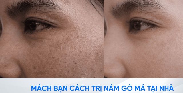 Làm thế nào để trị nám gò má dứt điểm ngay tại nhà, không xâm lấn? Làm thế nào để trị nám gò má dứt điểm ngay tại nhà, không xâm lấn?