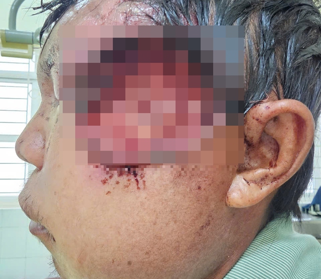 Dùng thuốc diệt cỏ vệ sinh vết thương, nam bệnh nhân hoại tử mặt, nhiễm dòi Dùng thuốc diệt cỏ vệ sinh vết thương, nam bệnh nhân hoại tử mặt, nhiễm dòi