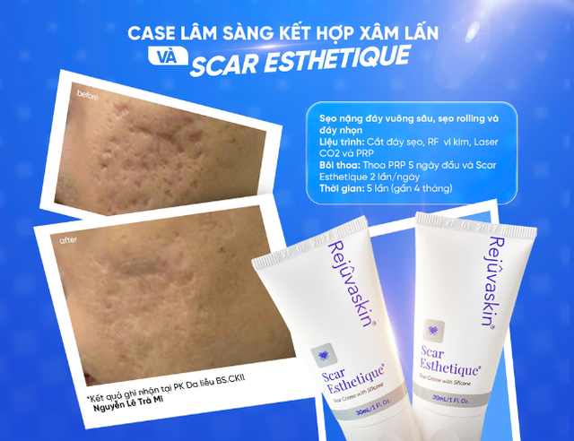 Kiến trúc làn da: ‘vật liệu’ nào giúp tái xây nền da, lấp đầy sẹo lõm? - Ảnh 4.