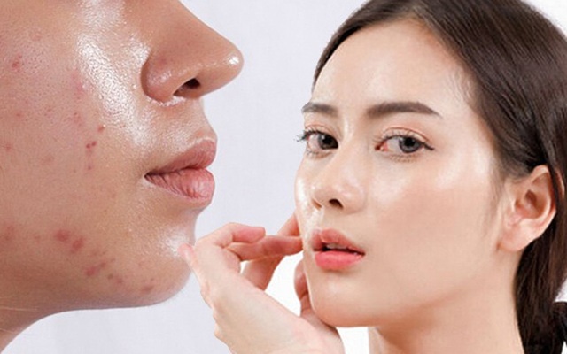 Top 7 kem chống nắng cho da dầu mụn khô thoáng, không bóng nhờn, không gây mụn