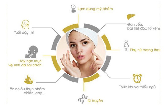 Bật mí 11 cách trị mụn nhanh, đơn giản tại nhà, ít tốn kém mà hiệu quả- Ảnh 2.