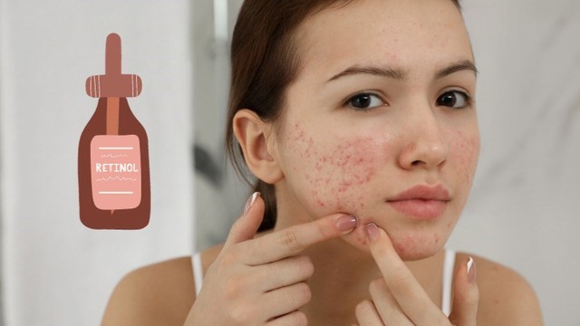 Bật mí 11 cách trị mụn nhanh, đơn giản tại nhà, ít tốn kém mà hiệu quả- Ảnh 5.