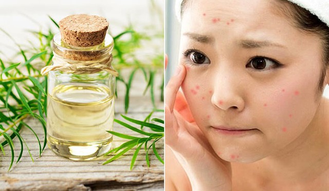 Bật mí 11 cách trị mụn nhanh, đơn giản tại nhà, ít tốn kém mà hiệu quả- Ảnh 8.