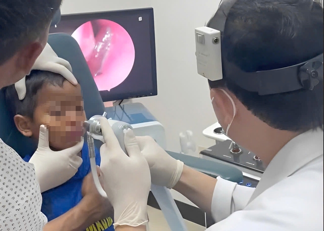 Gắp ra con đỉa sống ký sinh trong mũi bệnh nhi Gắp ra con đỉa sống ký sinh trong mũi bệnh nhi
