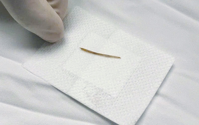 Bé trai 2 tuổi bị xương cá đâm thủng ruột - Ảnh 1.