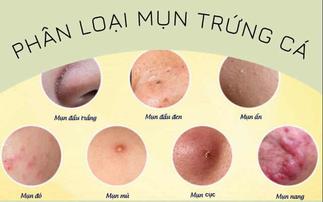Chi tiết cách trị mụn trứng cá hiệu quả ngay tại nhà từ thể nhẹ tới nặng - Ảnh 2.